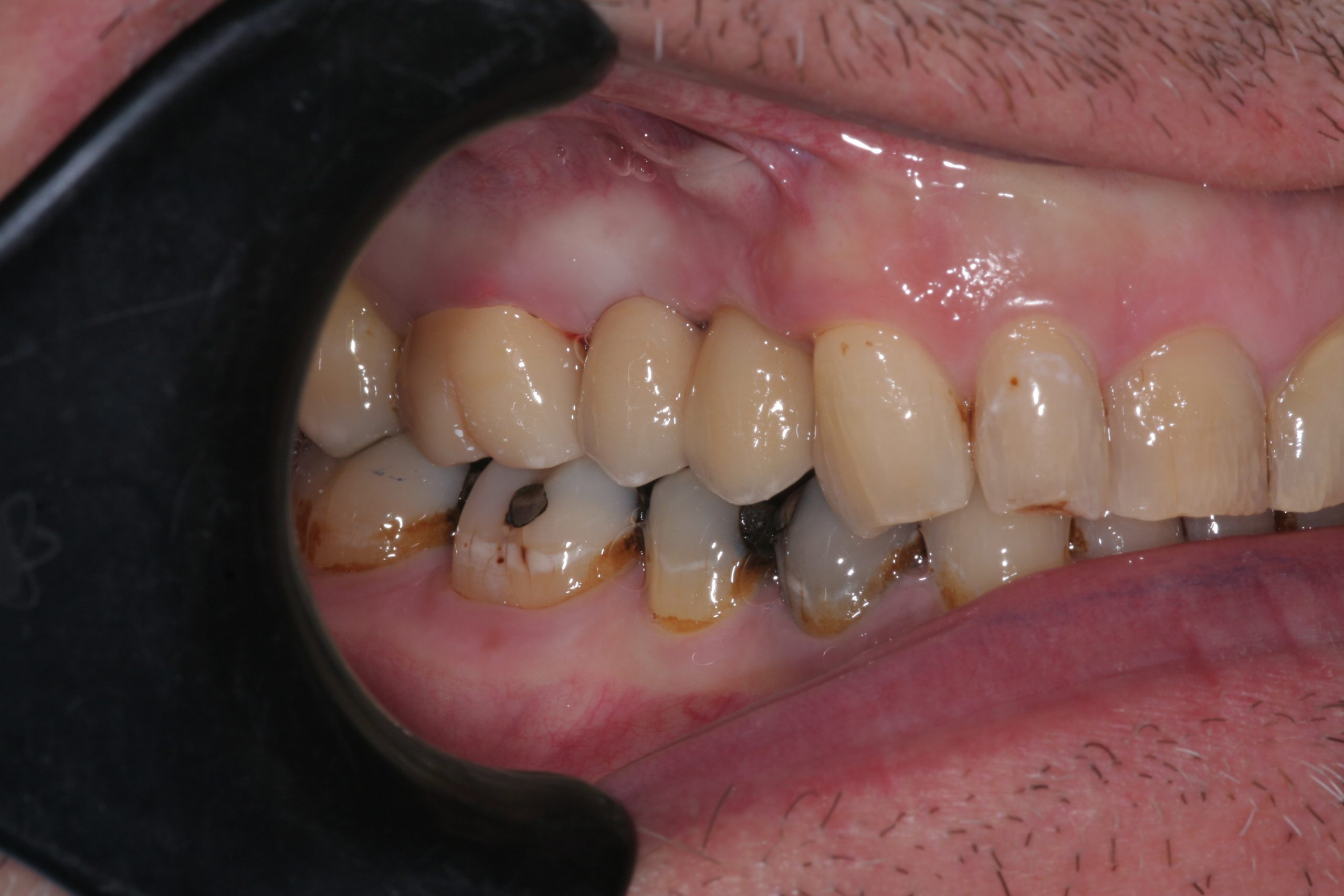implants-after