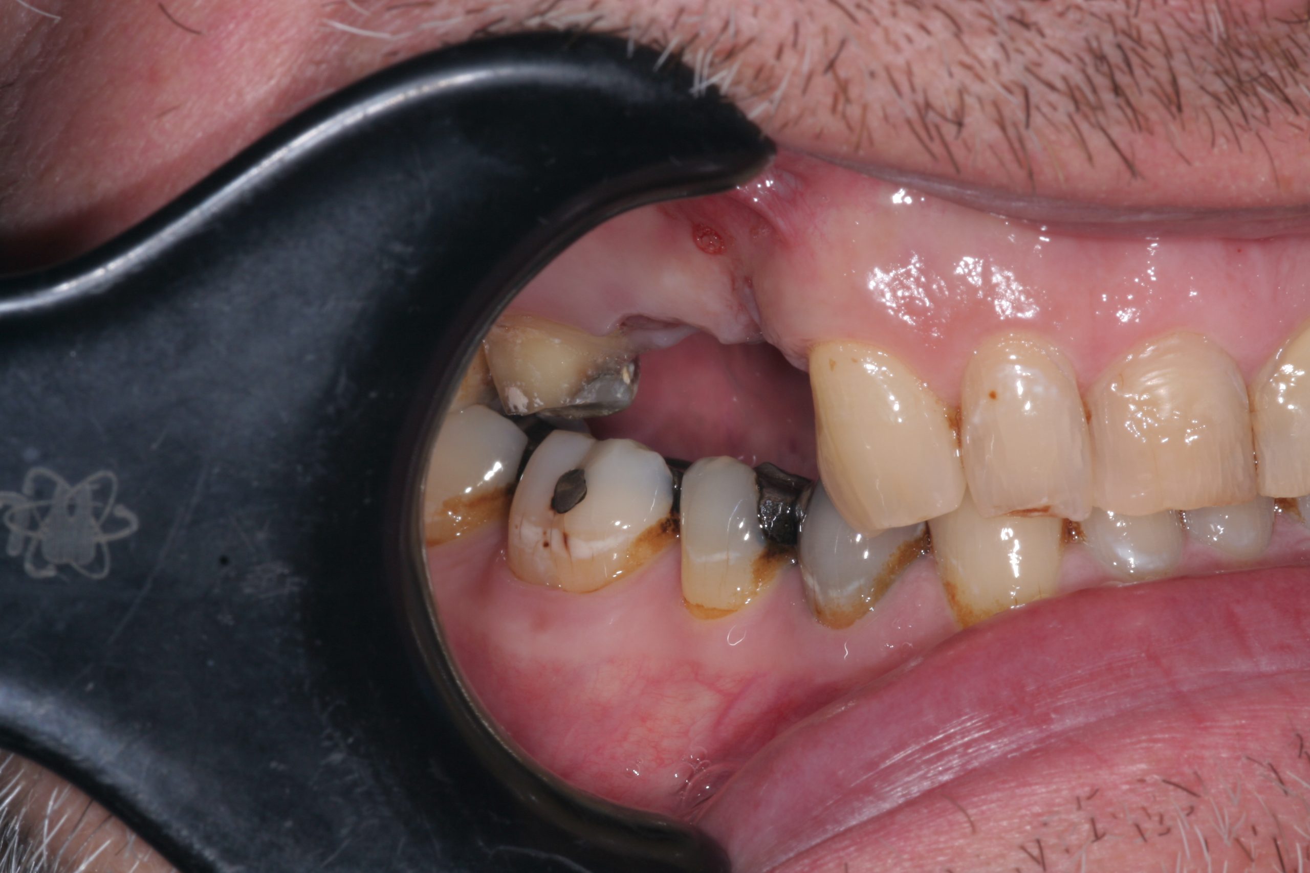 implants-before